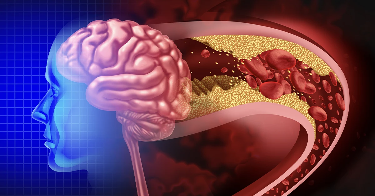 ¿Cuándo un ictus es grave?